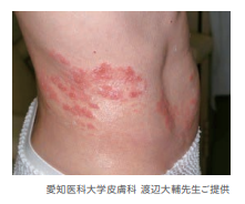 ピリピリ 痛い 皮膚 外傷は無いのに皮膚がヒリヒリします。
