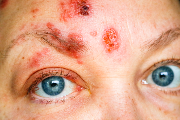 顔面に帯状疱疹ができた女性の写真