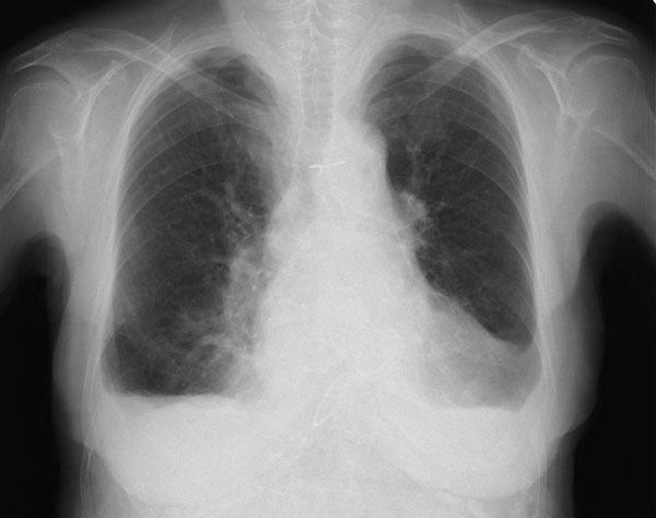 肺の写真