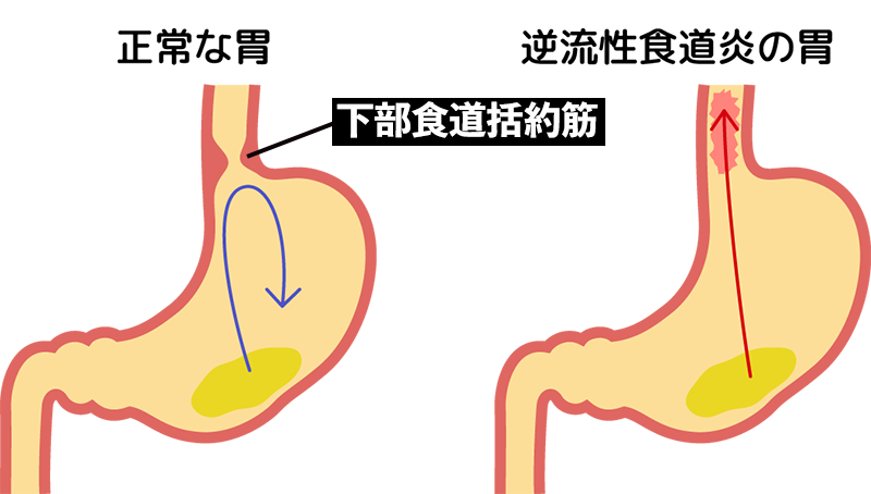 正常な胃と逆流性食道炎の胃の比較イラスト
