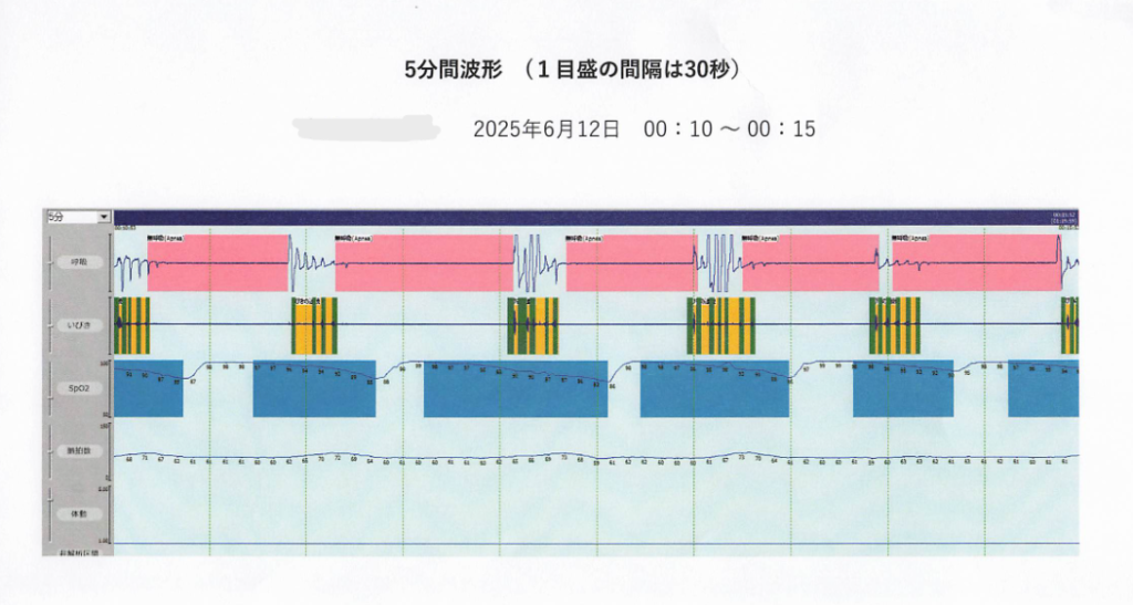 睡眠時無呼吸症候群の結果