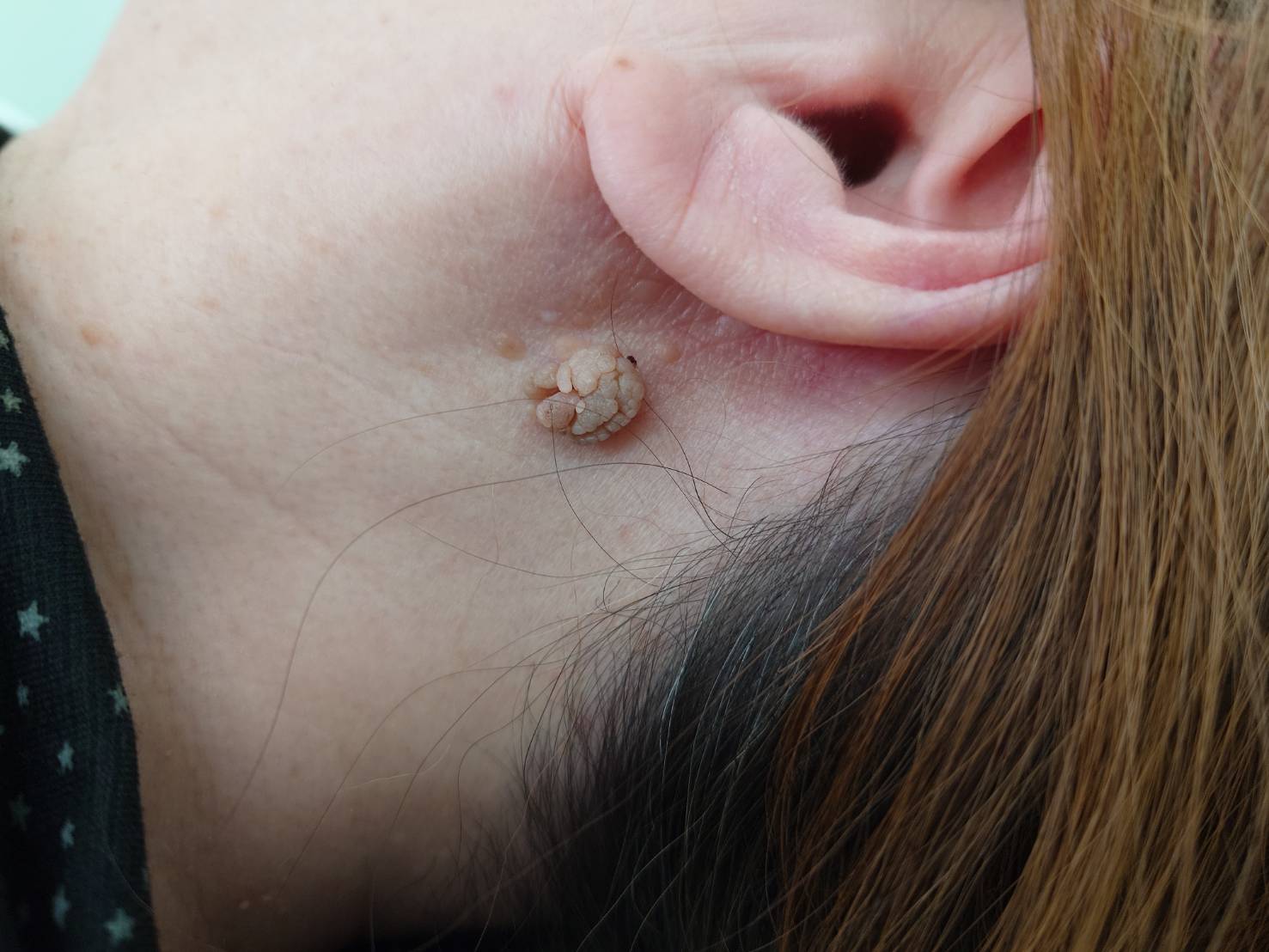 脂漏性角化症の術前