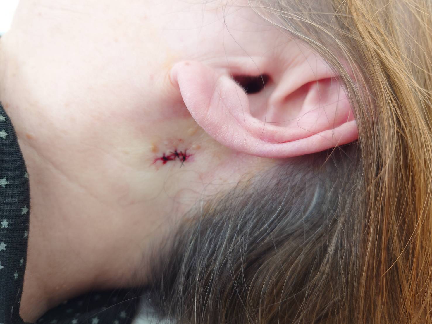 脂漏性角化症の切除・縫合後