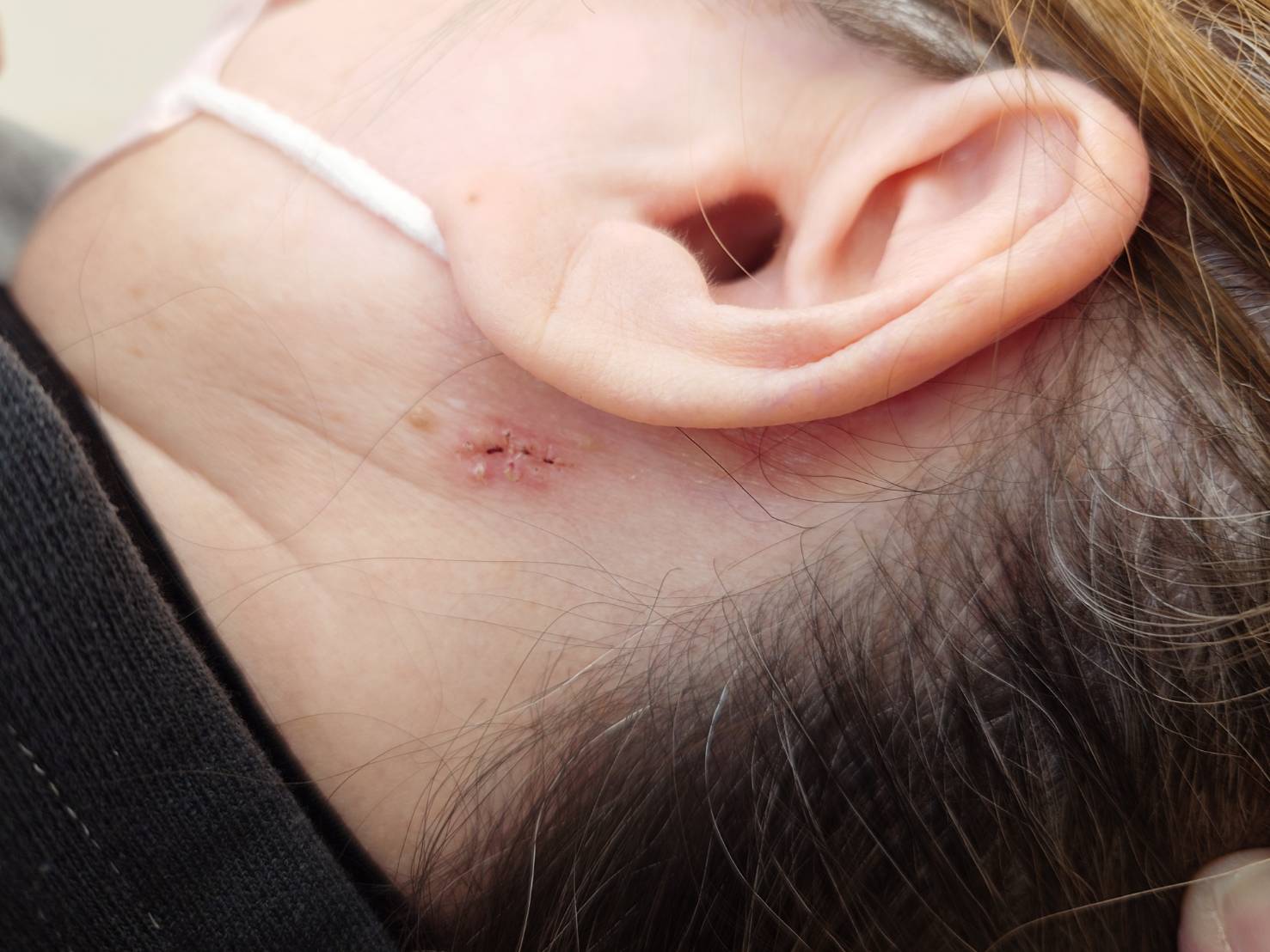 脂漏性角化症の抜糸後