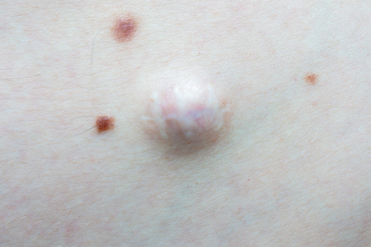 皮膚の「しこり」や「できもの」は日帰り手術で切除可能|粉瘤・脂肪腫・ホクロ【千葉・茂原市から通院可】 | 千葉県長生郡長生村のあまが台 ...