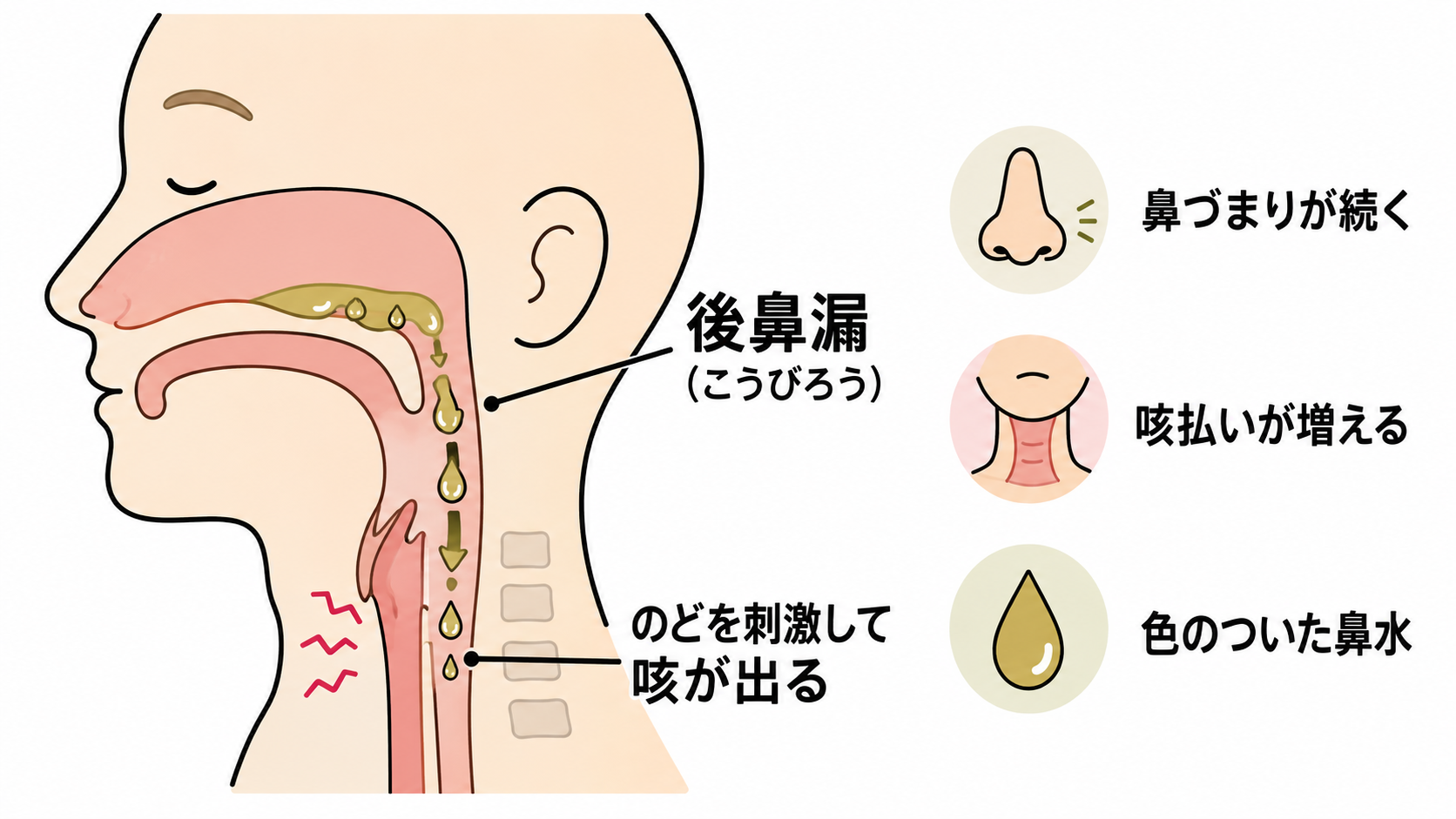 鼻水が喉へ流れる鼻副鼻腔の病気