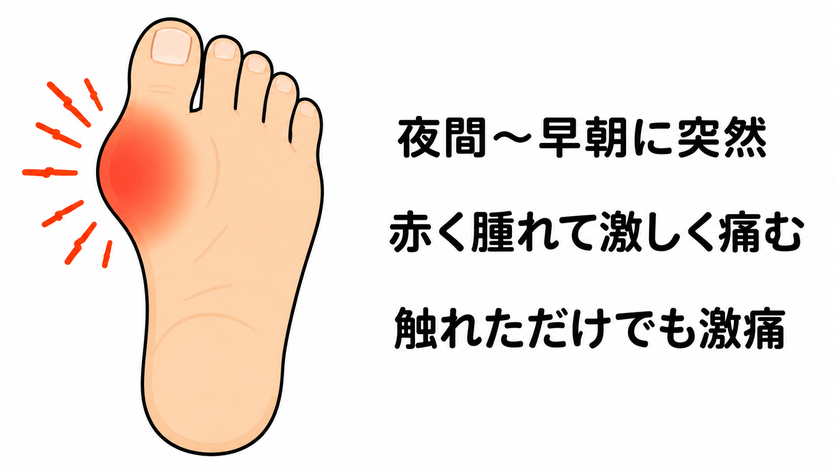 足の親指の付け根が赤く腫れる痛風発作のイラスト