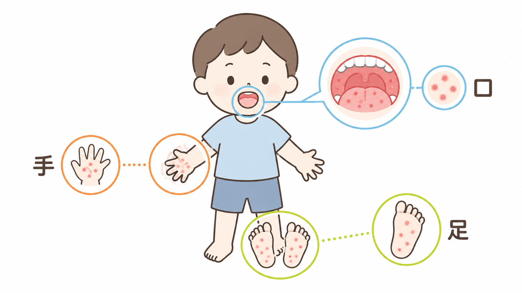 手足口病の症状が出やすい手・足・口の3か所を示す図